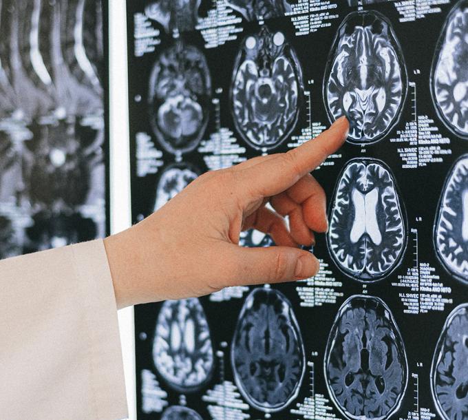 A researcher looks at a brain scan image.
